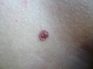 cutaneous angioma